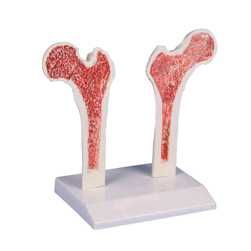 Erler Zimmer osteoporosis thigh model anatomical, life-size