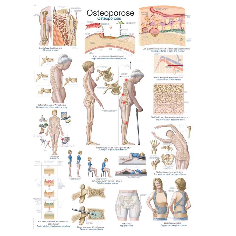 Erler Zimmer anatomical chart "osteoporosis", diff. Sizes