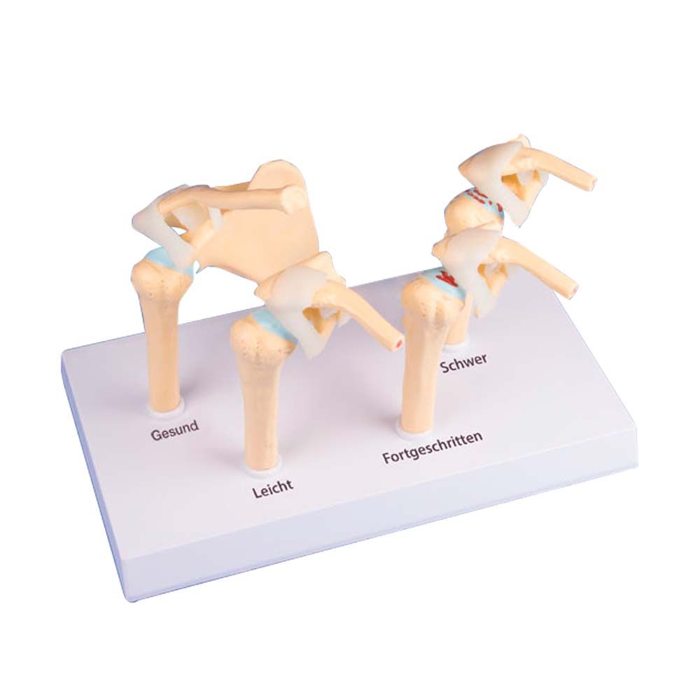 Erler Zimmer Model - 4-Stage Osteoarthritis Shoulder (OA)