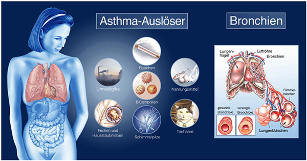 An inhalation device can help with asthma
