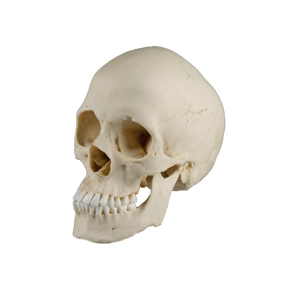 Erler Zimmer Skull Model, scapocephalic, 20 x 20 x 11,5 cm