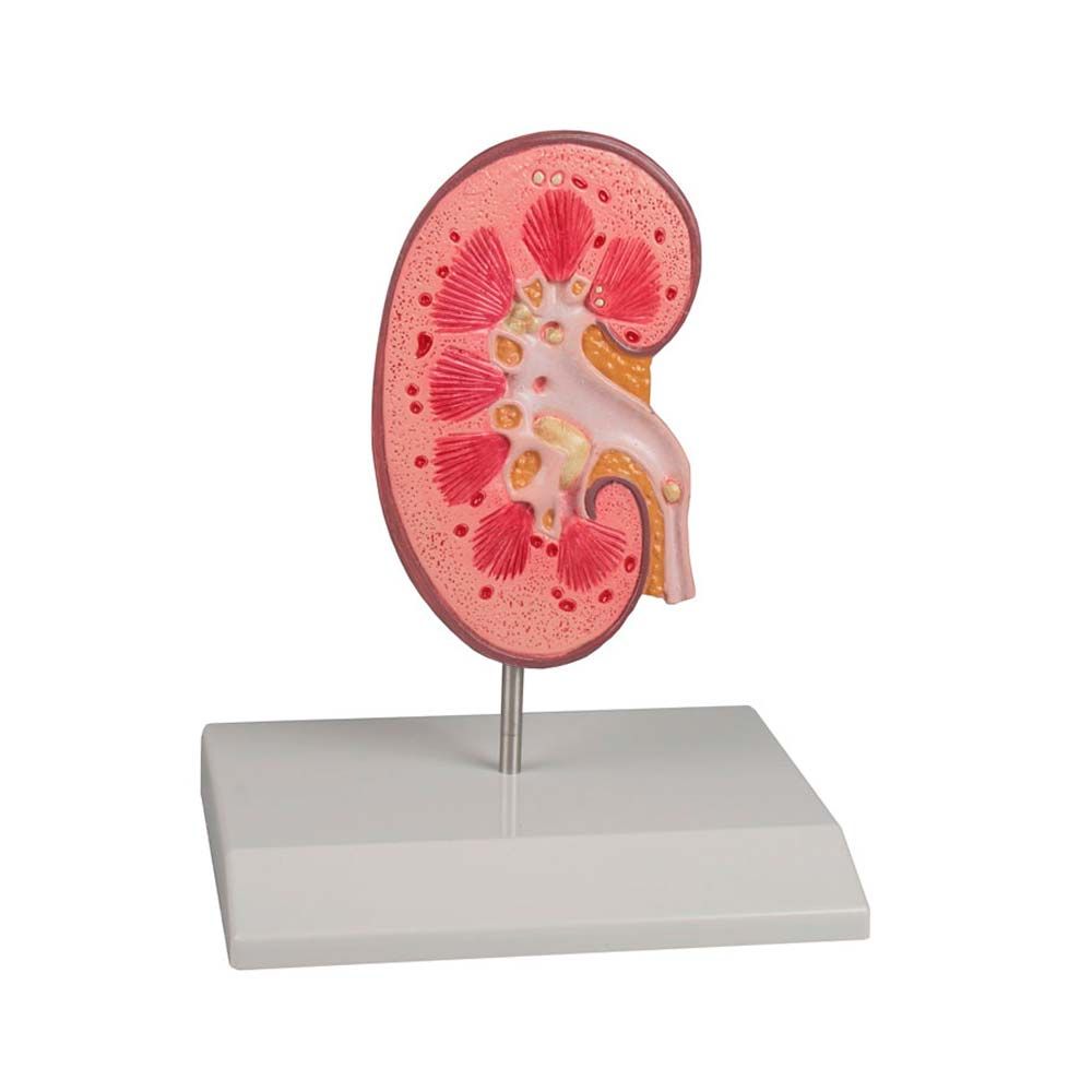 Erler Zimmer Desktop Model - Kidney Stone, Nephrolithiasis