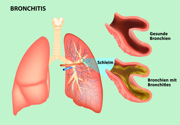 Therapeutic application of an inhalation device for bronchitis